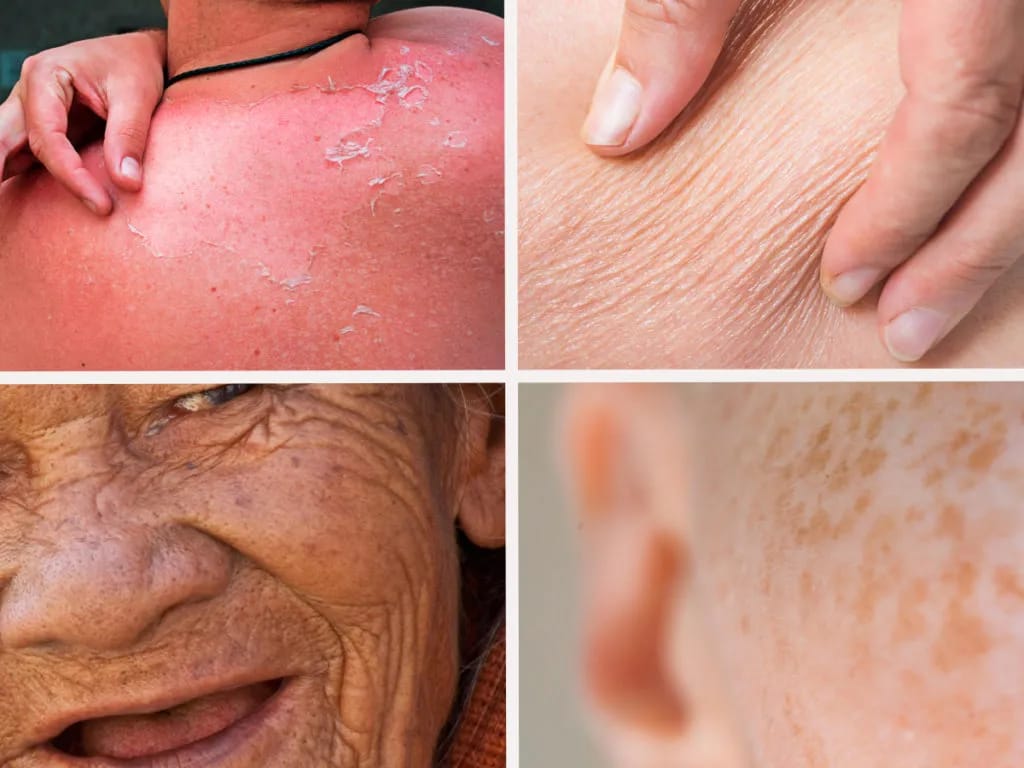 EFFECTS OF SUN DAMAGE