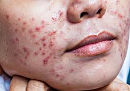 nodules and cysts acne