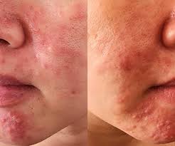 PAPULES AND PISTULES
